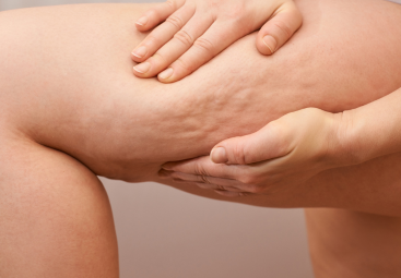 Cellulite Through Three Lenses: Science, TCM & Ayurveda