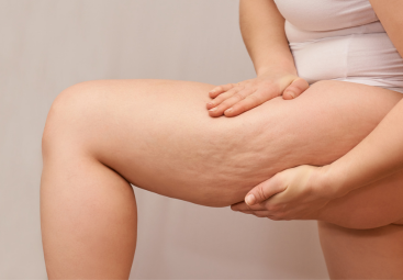 What Causes Cellulite | Cellulite Therapy & Flow Leggings