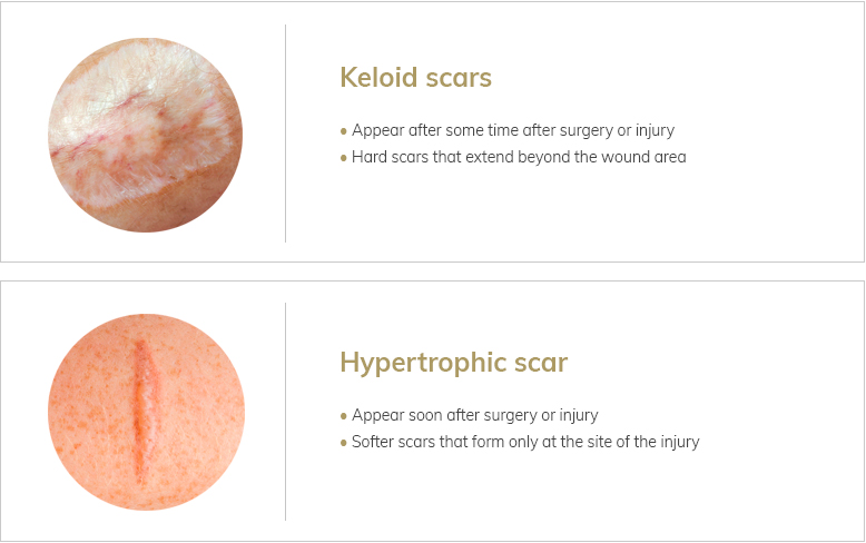 Keloid scar treatment silicone sheets store